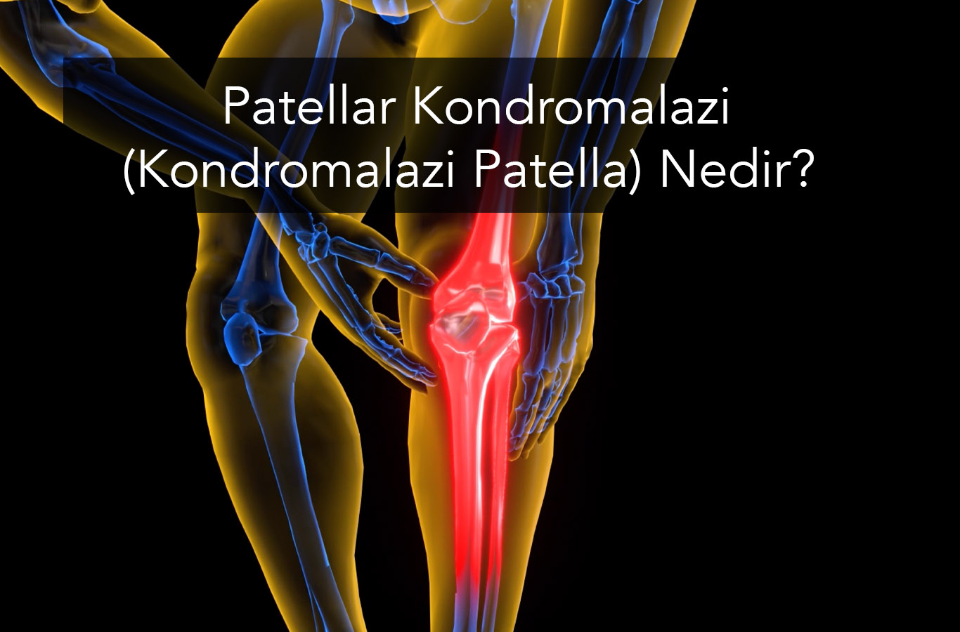 Patellar Kondromalazi (Kondromalazi Patella) Nedir?
