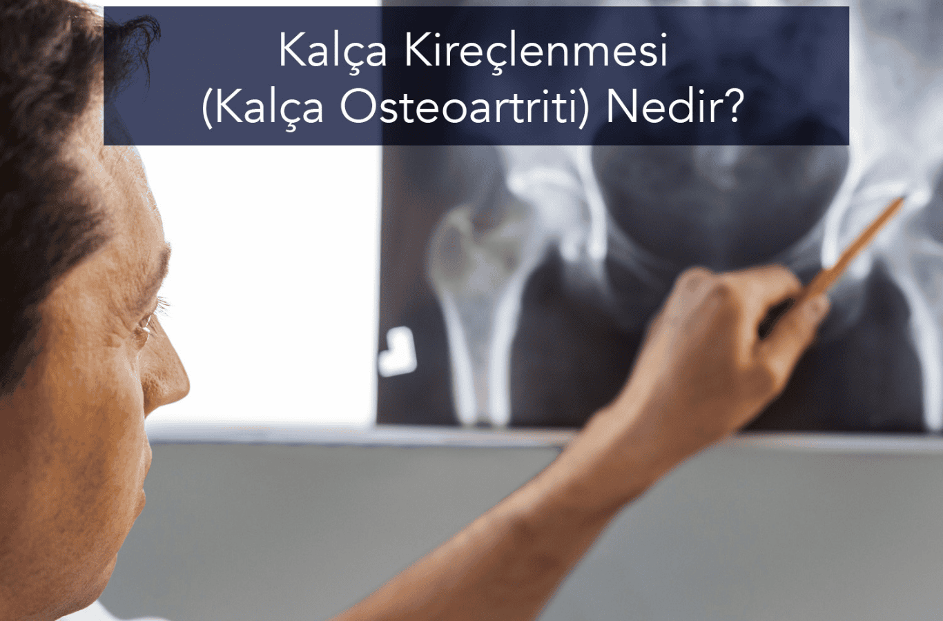 Kalça Kireçlenmesi / Kalça Osteoartriti Nedir? Belirtileri, Nedenleri ve Tedavi Yöntemleri