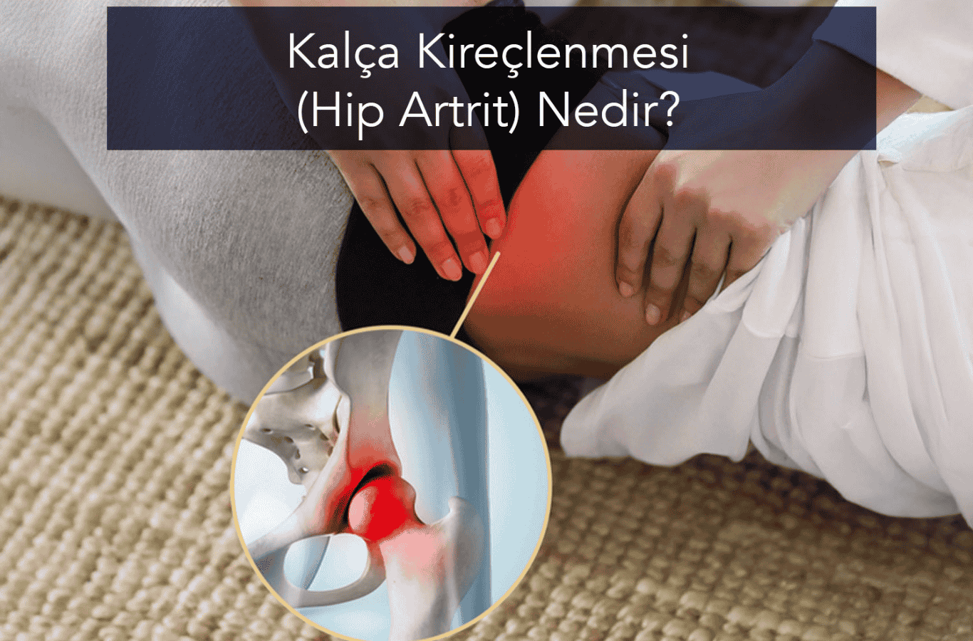 Kalça Kireçlenmesi (Hip Artrit) Nedir?