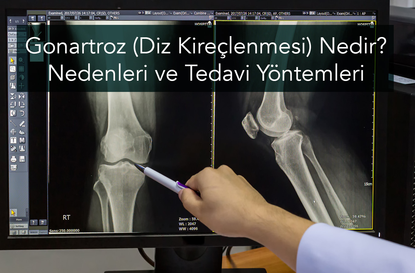 Gonartroz (Diz Kireçlenmesi) Nedir? Nedenleri ve Tedavi Yöntemleri