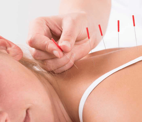 Akupunktur